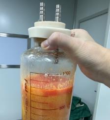 无棣水动力吸脂手术要做多久？
